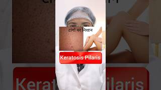 Keratosis Pilaris🦵क्या आपको भी है🤔 skin glow trending [upl. by Latsyrd412]