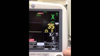 Capnography EtCO2 Monitoring [upl. by Demha]