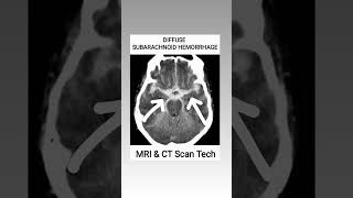 Subarachnoid Hemorrhage CT Scan viral youtubeshorts ct shortsfeed [upl. by Smada]