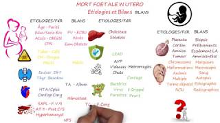 MORT FŒTALE IN UTERO 2è Partie  Étiologies et Bilans [upl. by Nnyrat]