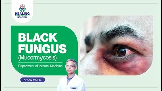 Black Fungus Mucormycosis  Causes Symptoms Treatment amp Prevention  Healing Hospital Chandigarh [upl. by Goulden]