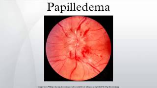 Papilledema [upl. by Allan]