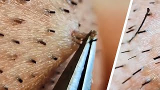 Ingrown hair removal compilation😌 [upl. by Orv851]