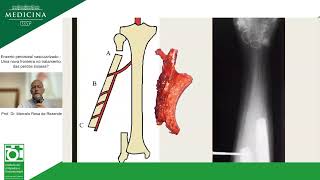 Enxerto periosteal vascularizado  Uma nova fronteira no tratamento das perdas ósseas [upl. by Llerrem]