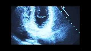 Living with Mitral Valve Prolapse [upl. by Aicargatla]