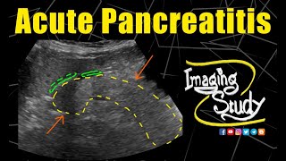 Acute Pancreatitis  Ultrasound  Case 160 [upl. by Eitnom976]