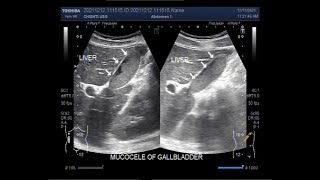 The Gallbladder Mucocele distention [upl. by Vig]