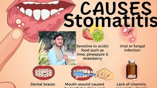 Stomatitis Chapter1 Disease1 AHN 3rd semester kmu slides in pashto drnajeebnote drnajeeb kmupdat [upl. by Bobker]