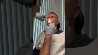 Nasal splint removal one week after Septoplasty [upl. by Nomzed]