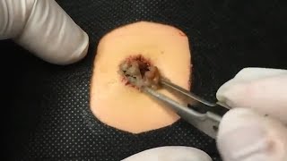 BEST Pimple Popping  Whiteheads Removal  Big Cystic Acne Blackheads  Squeezing Pimples  Tr0039 [upl. by Gnof]