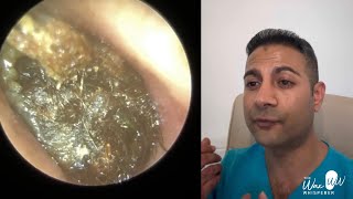 1515  Accident amp Emergency Keratosis Obturans Removal  Rai Ear Pick Comes to the Rescue [upl. by Eirellam102]