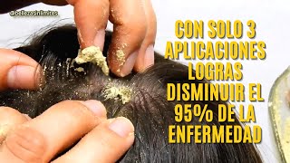 Remedio Casero para Psoriasis  Dermatitis Seborreica  Seborrea  Caspa [upl. by Ribaudo699]