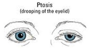 Ptosis MY Before amp After [upl. by Enelaehs648]