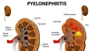 pyelonephritispathology bsc nursing 4th semester [upl. by Aloisius]