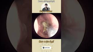 rhinorrhea sinusitis bersihkankuping satisfyingvideos pembersihan telinga video puas hati [upl. by Anny]