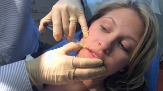 Juvederm Lip Augmentation in Richmond VA [upl. by Kyre]