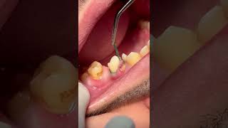 Removing retraction cord after tooth RCT amp composite restoration [upl. by Barkley]