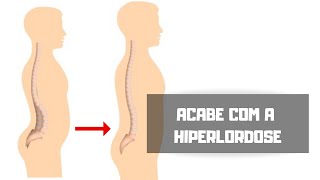 HIPERLORDOSE  COMO CORRIGIR ACABE COM A DOR NAS COSTAS [upl. by Aiksas845]