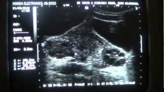 ULTRASOUND POLYCYSTIC OVARIES [upl. by Wolff395]