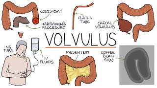 Understanding Volvulus Twisted Bowel [upl. by Gilud287]