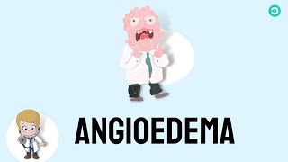 Angioedema signs amp symptoms causes and treatment [upl. by Conlon]