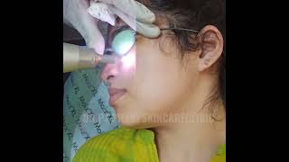 Laser Treatment for the Removal of Dark Spots [upl. by Avril]