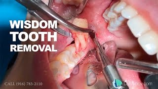 Wisdom tooth removal in 5 MIN or less Surgical Guide Online Course  Free eBook [upl. by Mihar589]