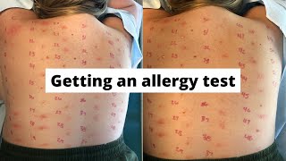 ALLERGY TEST  FIRST TIME AT AN ALLERGIST [upl. by Idette]