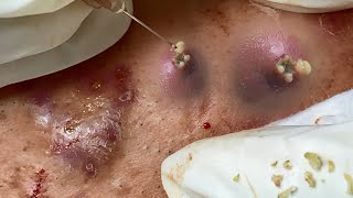 Big Cystic Acne Blackheads Extraction Blackheads amp Milia Whiteheads Removal Pimple Popping [upl. by Nyliuqcaj]