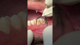 Cleaning teeth 🦷 dental scaling satisfying [upl. by Emirac285]