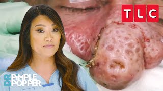 Bumpiest Nose Growths  Dr Pimple Popper  TLC [upl. by Kcinomod]