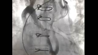 Subclavian venogram before pacemaker implantation [upl. by Elem798]