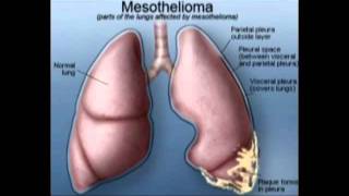 What Is Mesothelioma [upl. by Irollam]