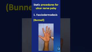 Shorts 59 Part 2  Static procedures for ulnar nerve palsy  procedures and modifications [upl. by Filiano183]