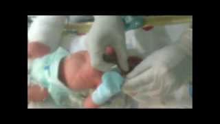 Neonatal Digital Intubation Part 1 [upl. by Clay]