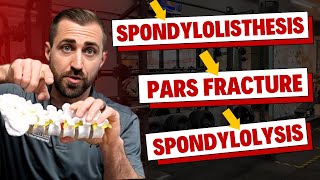 Guide to Diagnosing Spondylolysis and Spondylolisthesis for Physical Therapists [upl. by Leyes286]