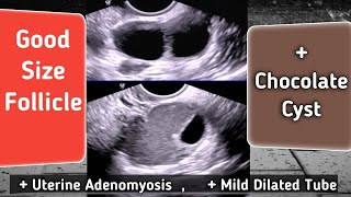 Good Size Ovarian Follicles  TVS Ultrasound  Chocolate Cyst [upl. by Ulysses]