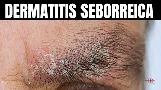 Dermatitis Seborreica Causas Síntomas y Tratamientos [upl. by Gorrono]