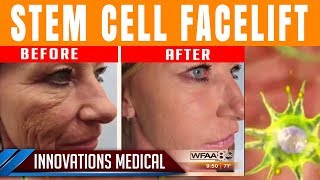 Stem Cell Facelift Before amp After 50 and gets carded for ALCOHOL [upl. by Ainerol]