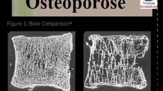 Ostéoporose Conduite à Tenir Traitement Prévention des Fractures [upl. by Kcirdneh]