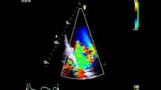 SEVERE MITRAL REGURGITATION [upl. by Shalna]