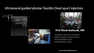 Ultrasound guided plantar fasciitis heel spur injection [upl. by Ahtnams895]