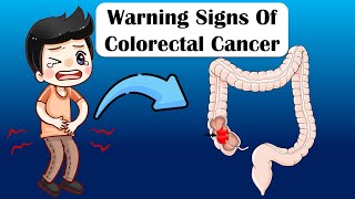 Warning Signs Of Colon Cancer  What Are The Early Signs amp Symptoms Of Colon Cancer [upl. by Gusta]