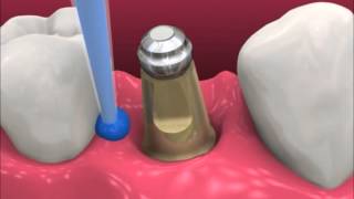 Smyl Manatee  Dental Implant Procedure [upl. by Jack59]