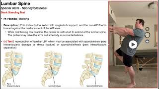 Stork Standing Test for Spondylolisthesis  Rationale amp Interpretation [upl. by Ased567]