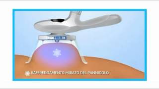 LipoFreeze  la nuova tecnologia per eliminare pancia e maniglie dellamore [upl. by Grobe653]