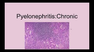 Chronic Pyelonephritis [upl. by Esimaj938]