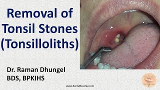 Tonsil Stone Removal  Tonsillolith removal by Dr Raman Dhungel [upl. by June]