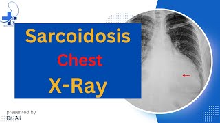 Sarcoidosis Chest XRay Chest X Ray Findings [upl. by Leipzig408]