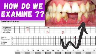 PERIODONTAL EXAMINATION ‖ HOW TO EXAMINE PERIODONTITIS PATIENT  ‖ PERIO HUB ‖ Dr SNEHA [upl. by Akinihs]